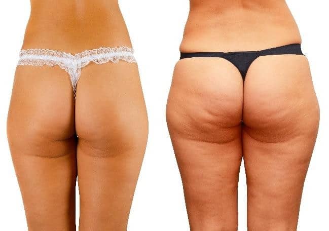 cellulite reduction